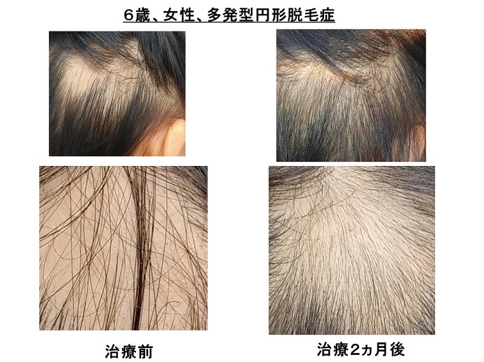 円形脱毛症　病院